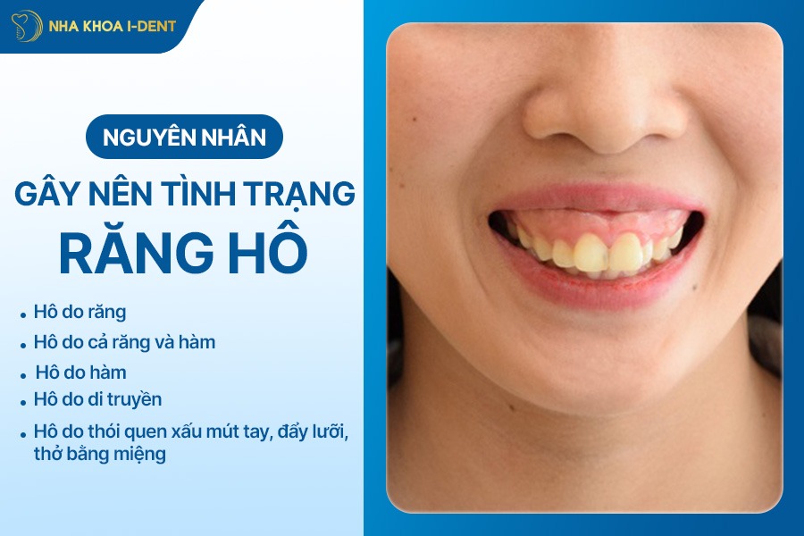 nguyên nhân răng hô