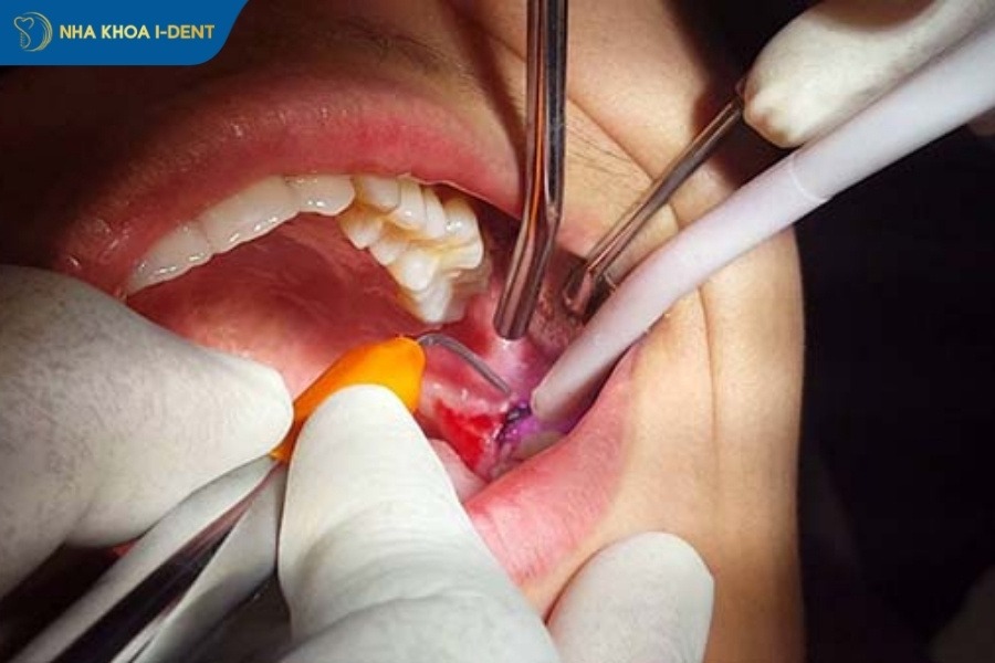 nhổ răng có bị đau không