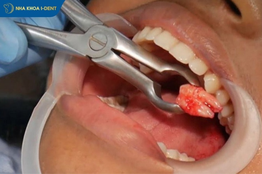 nhổ răng hàm có đau không