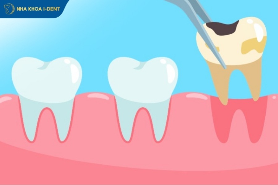 nhổ răng sâu có đau không