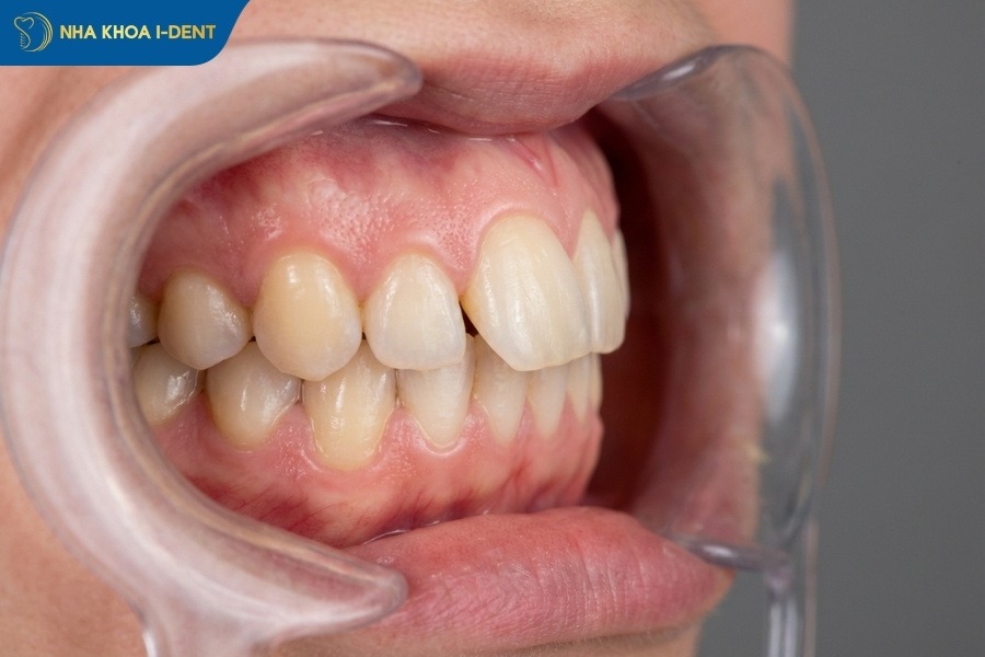 niềng 2 răng cửa bị lệch