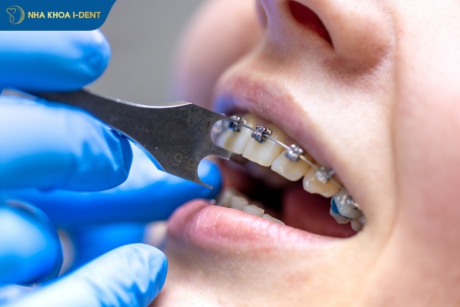 niềng 2 răng cửa