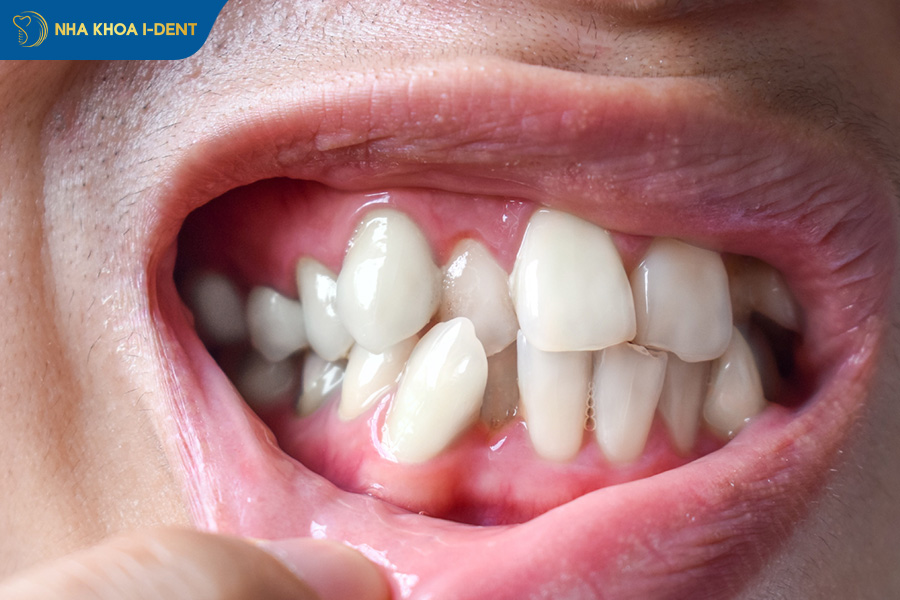 niềng răng bao lâu