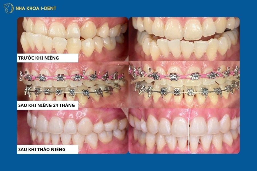 thời gian niềng răng nhanh nhất là bao lâu