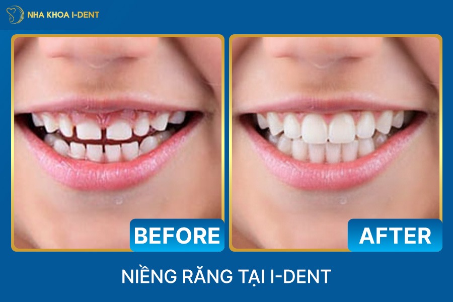 niềng răng cho trẻ 8 tuổi giá bao nhiêu