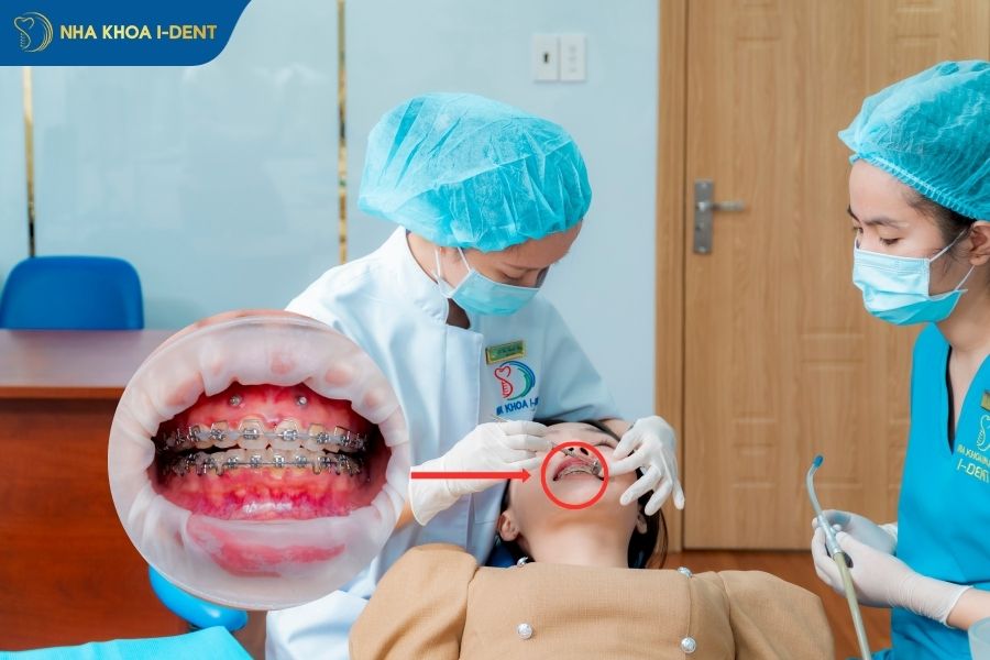 niềng răng có đau hay không;