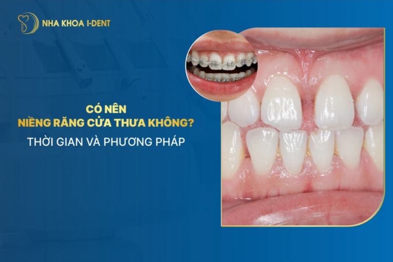 Có nên niềng răng cửa thưa không? Thời gian và phương pháp