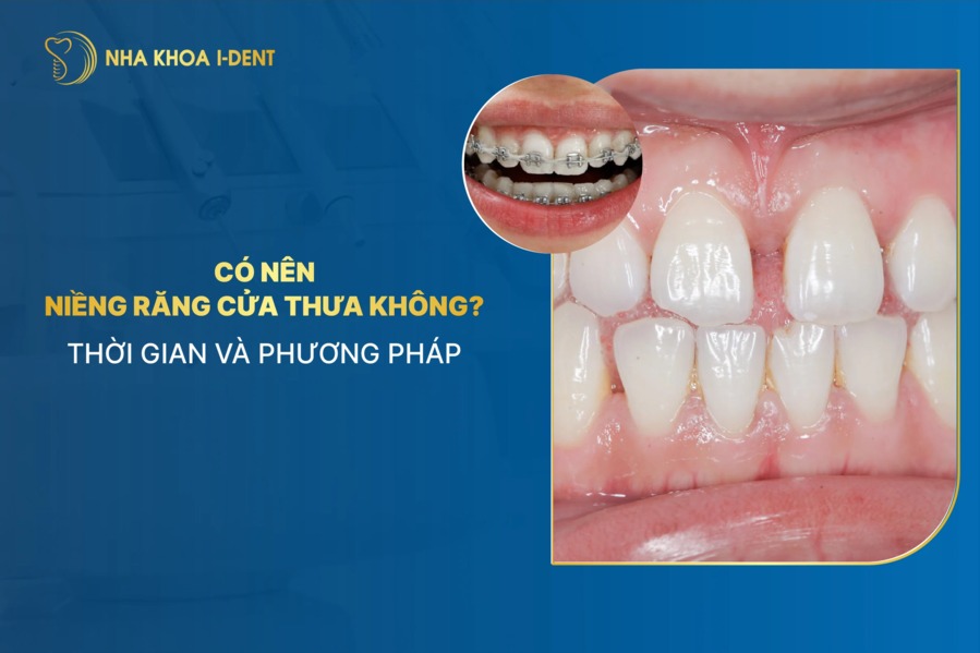 Có nên niềng răng cửa thưa không? Thời gian và phương pháp