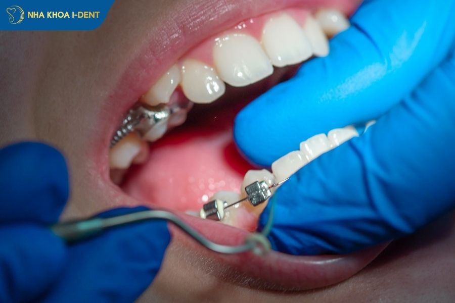 niềng răng đau không