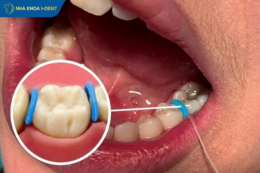 niềng răng đau nhất giai đoạn nào