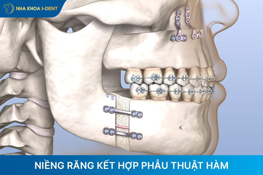 chỉnh răng hô bằng phương pháp niềng răng kết hợp phẫu thuật hàm
