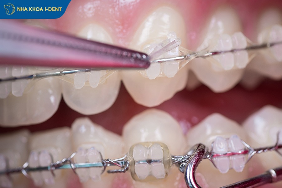 Niềng răng mắc cài sứ.