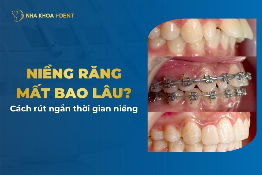 Niềng răng mất bao lâu? Thời gian tối thiểu, cách giảm thời gian niềng