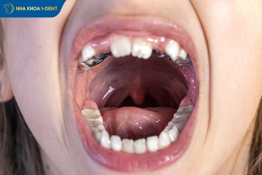 niềng răng mặt lưỡi