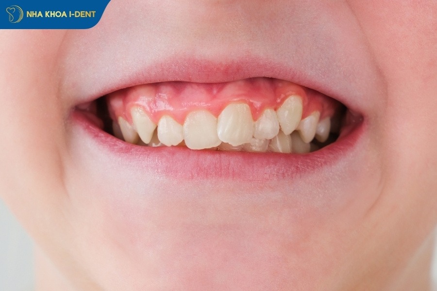 niềng răng rẻ nhất