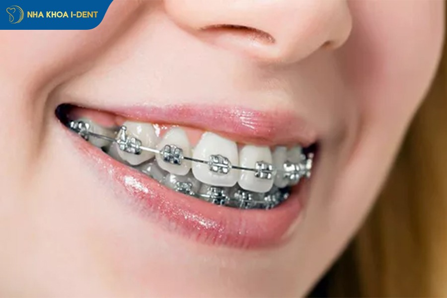 niềng răng thưa