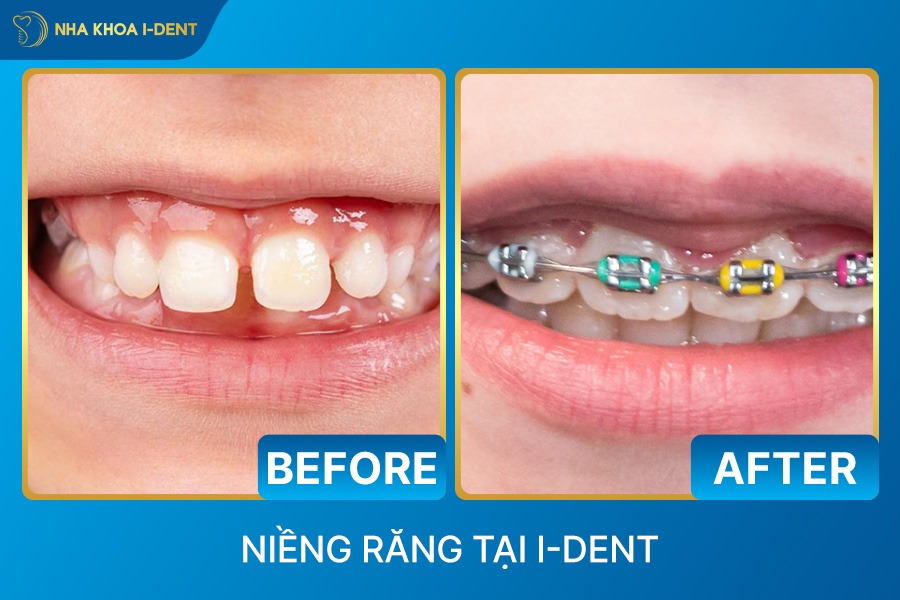 niềng răng trẻ em