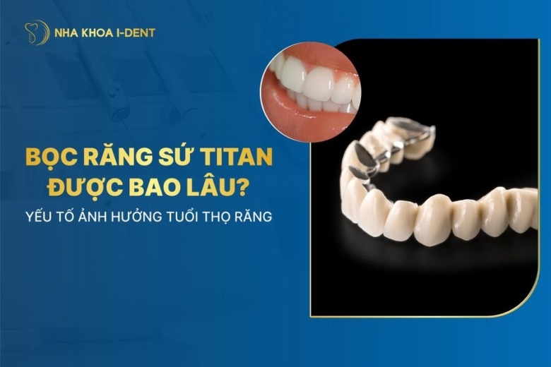 Bọc răng sứ Titan được bao lâu? Yếu tố ảnh hưởng tuổi thọ răng