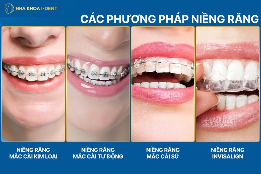 răng thưa có niềng được không