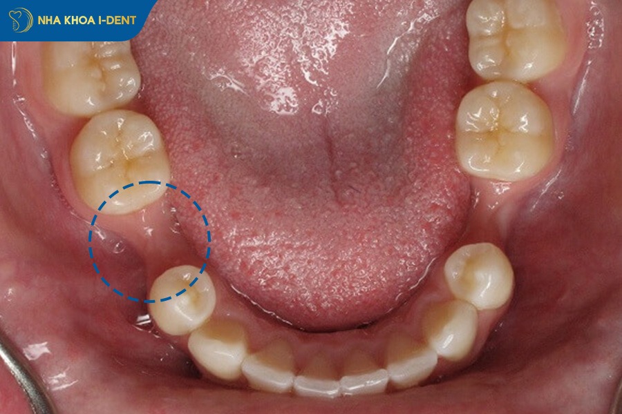 tiêu xương hàm tại vị trí mất răng số 5
