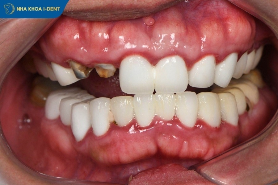 trồng răng sứ bao nhiêu