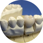 Ceramco 3  Metal-Ceramic Crown