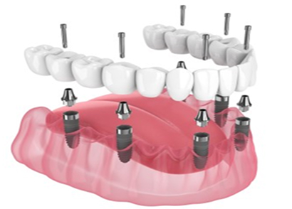 All-on-6 Dental Implant Treatment