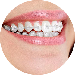 NIỀNG RĂNG MẮC CÀI SỨ