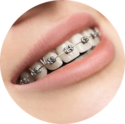 NIỀNG RĂNG MẮC CÀI KIM LOẠI