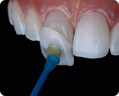 What Is Veneer Bonding?