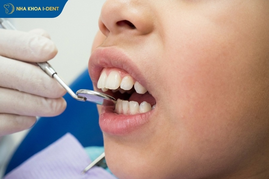 Niềng răng khi xương hàm trên của bé phát triển quá mức