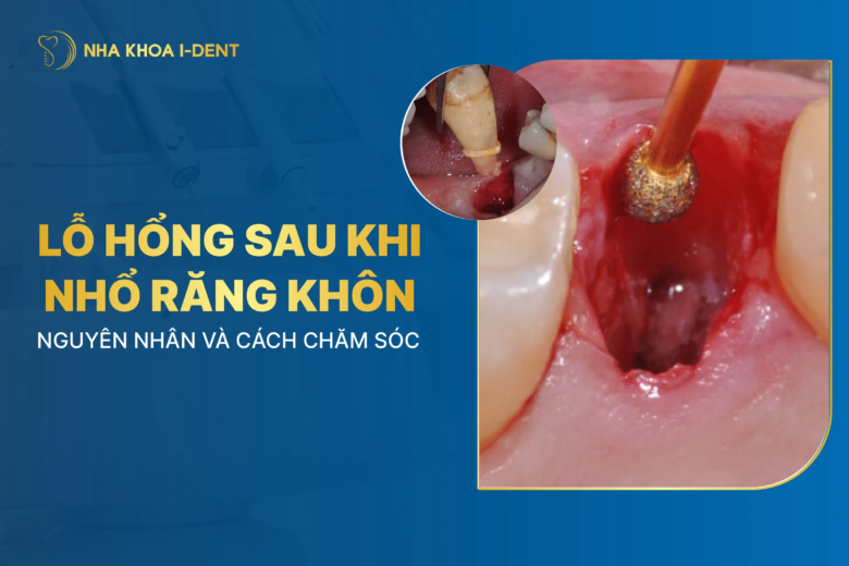 Lỗ hổng sau khi nhổ răng khôn: Nguyên nhân và cách chăm sóc