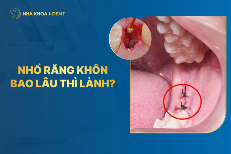 Nhỏ răng khôn bao lâu thì lành? Làm gì để lành thương nhanh? 