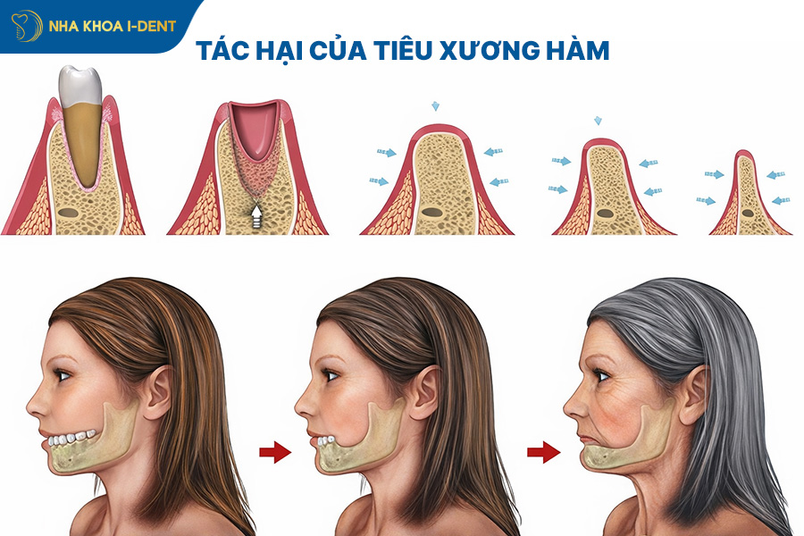 bị tiêu xương hàm có niềng răng được không
