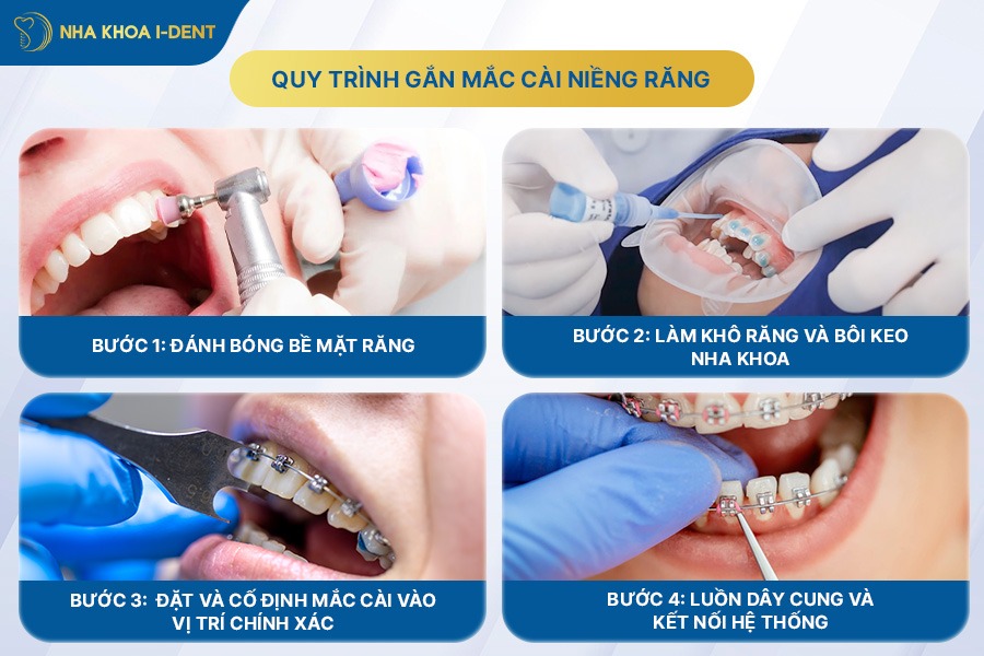 Quy trình gắn mắc cài niềng răng