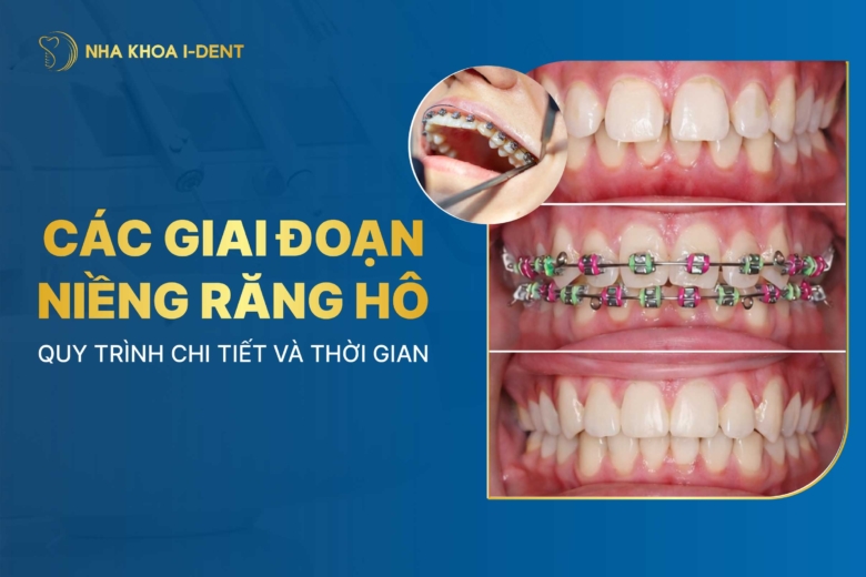 Các giai đoạn niềng răng hô đầy đủ và chi tiết quy trình