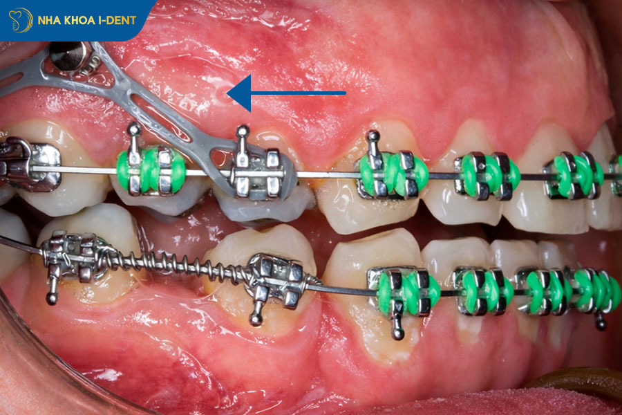 các giai đoạn niềng răng hô hàm