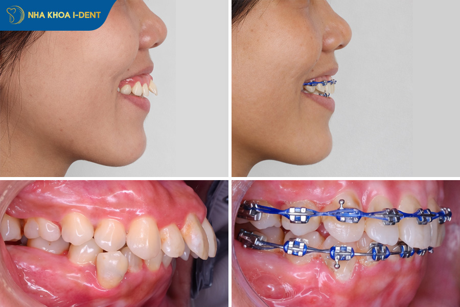 các giai đoạn niềng răng hô răng