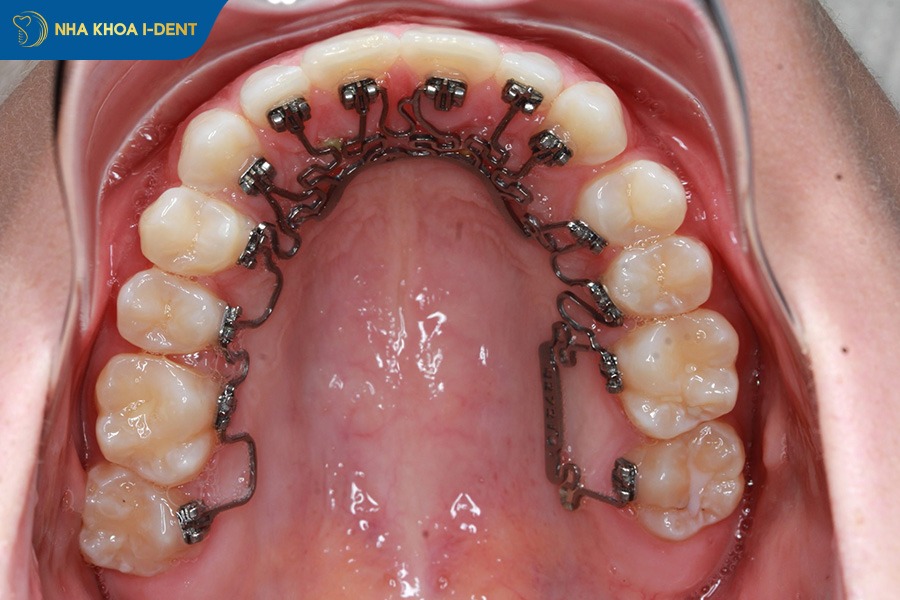 các phương pháp niềng răng hiện nay