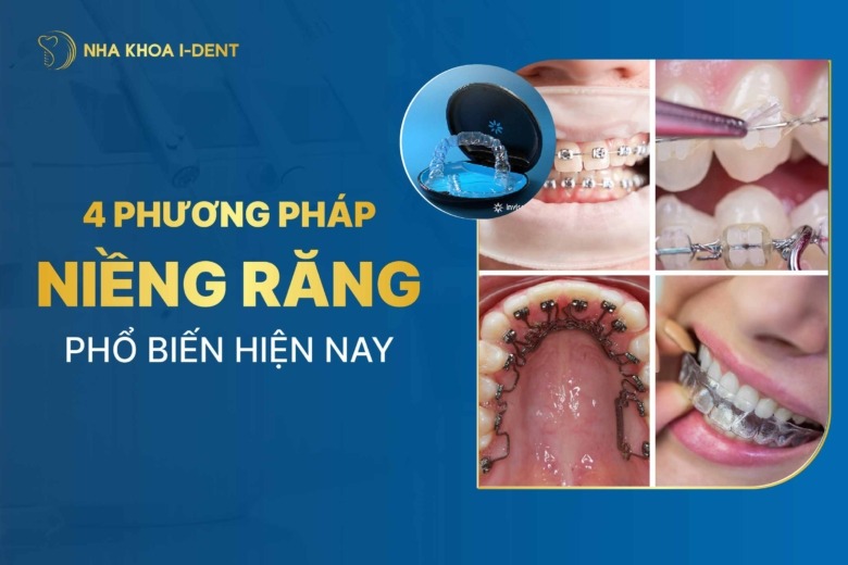 TOP 4 phương pháp niềng răng phổ biến hiện nay