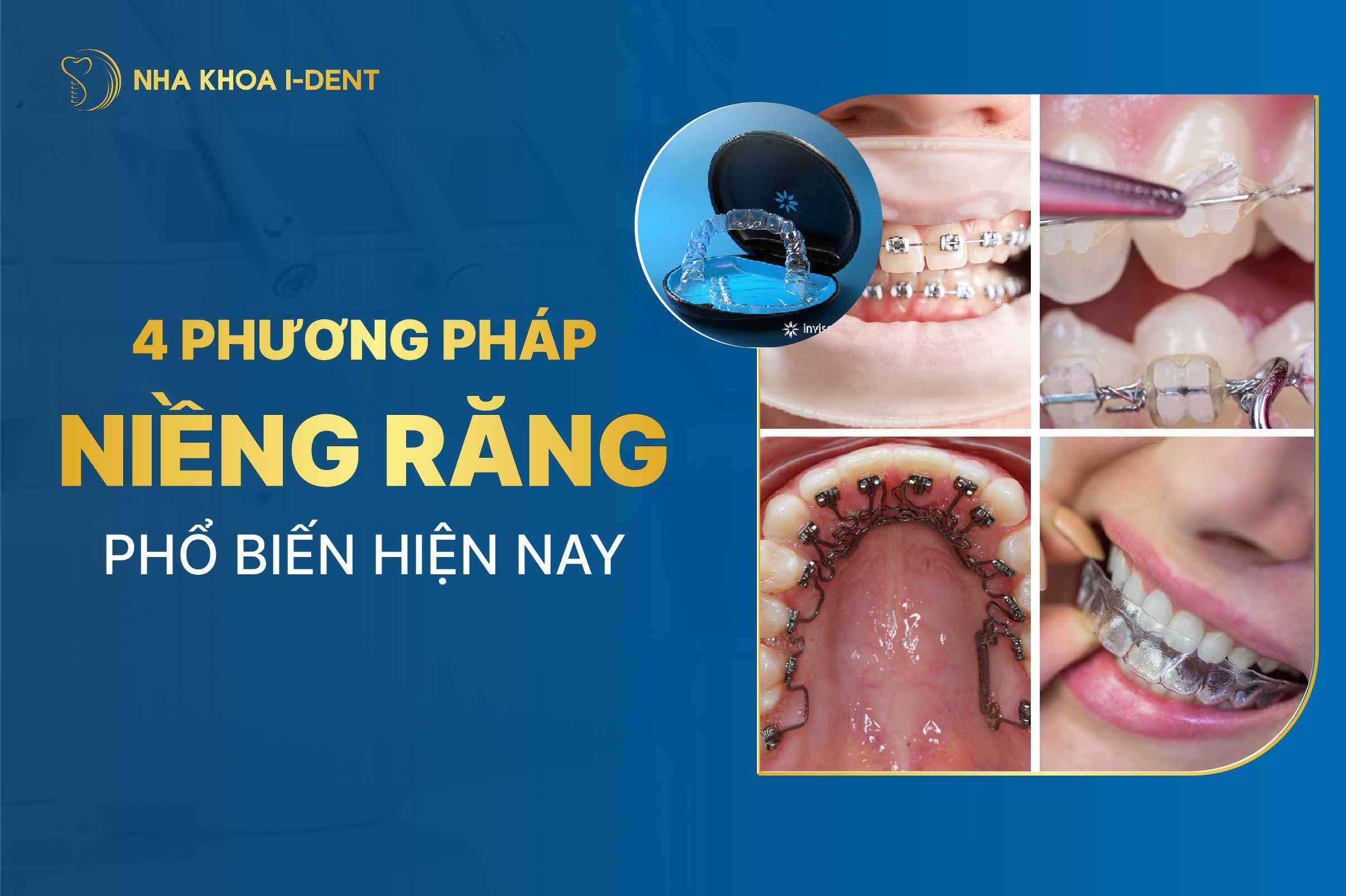 TOP 4 phương pháp niềng răng phổ biến hiện nay