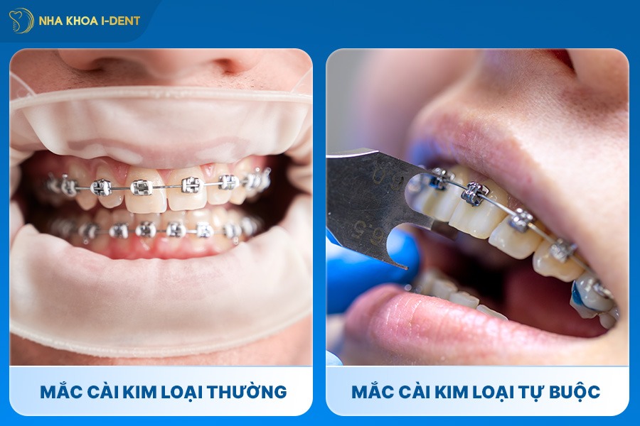 phương pháp niềng răng