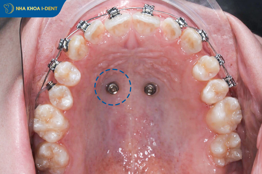 cắm vít niềng răng bao lâu thì tháo