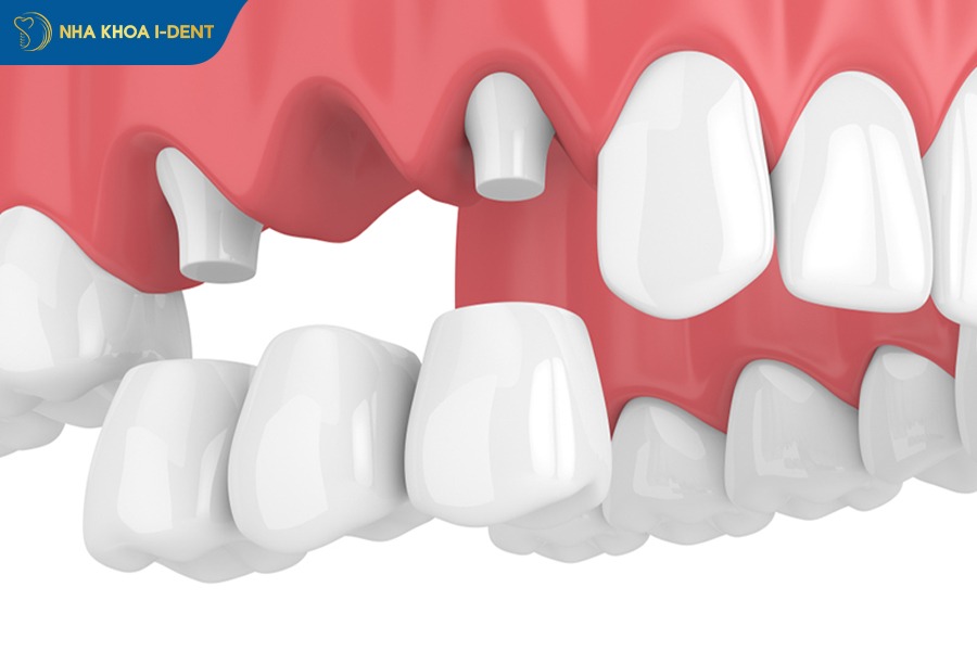 Làm cầu sứ răng số 4