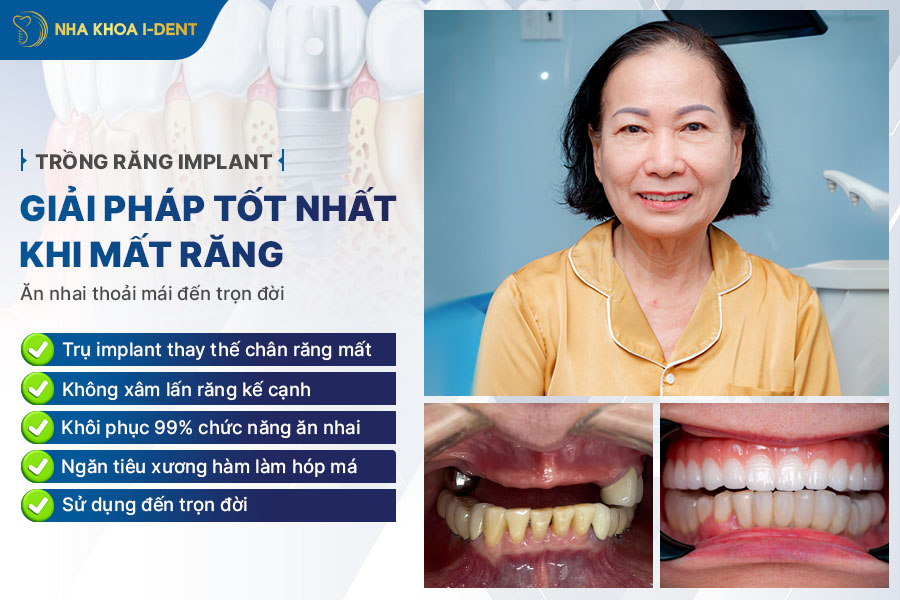 cầu răng và implant