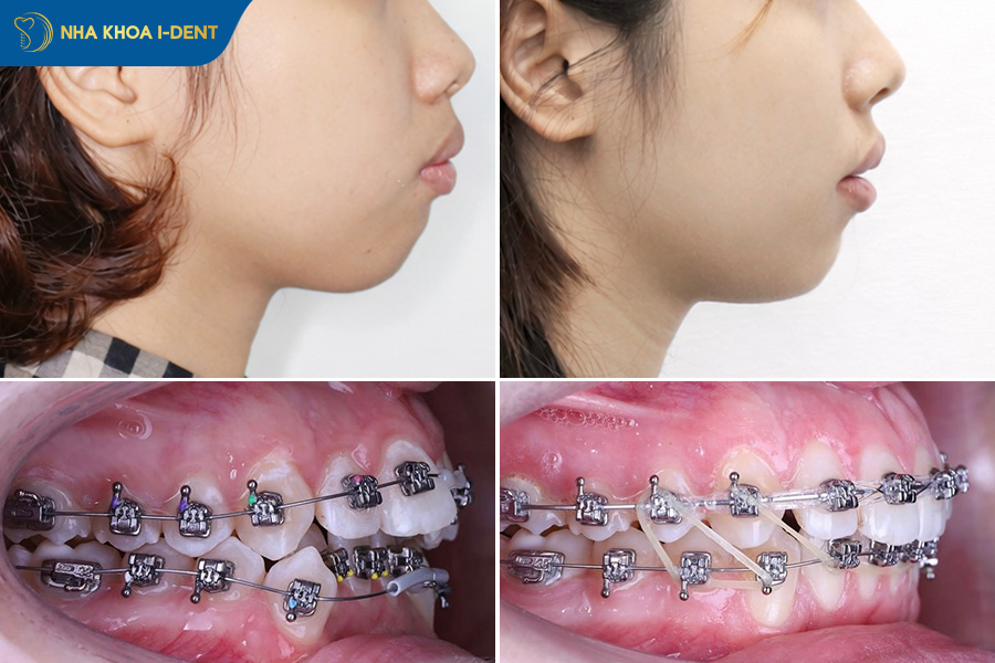 dấu hiệu sắp tháo niềng răng