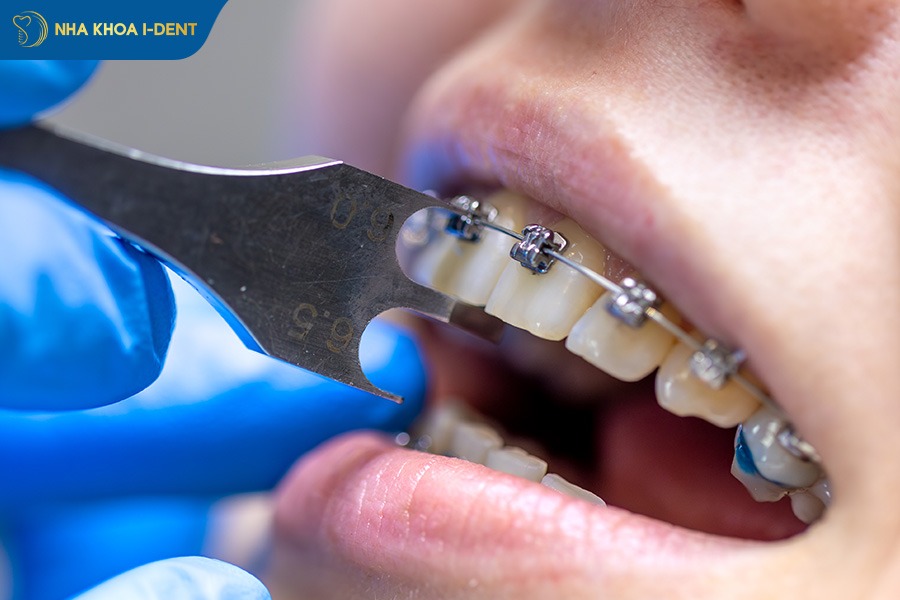 gắn mắc cài niềng răng
