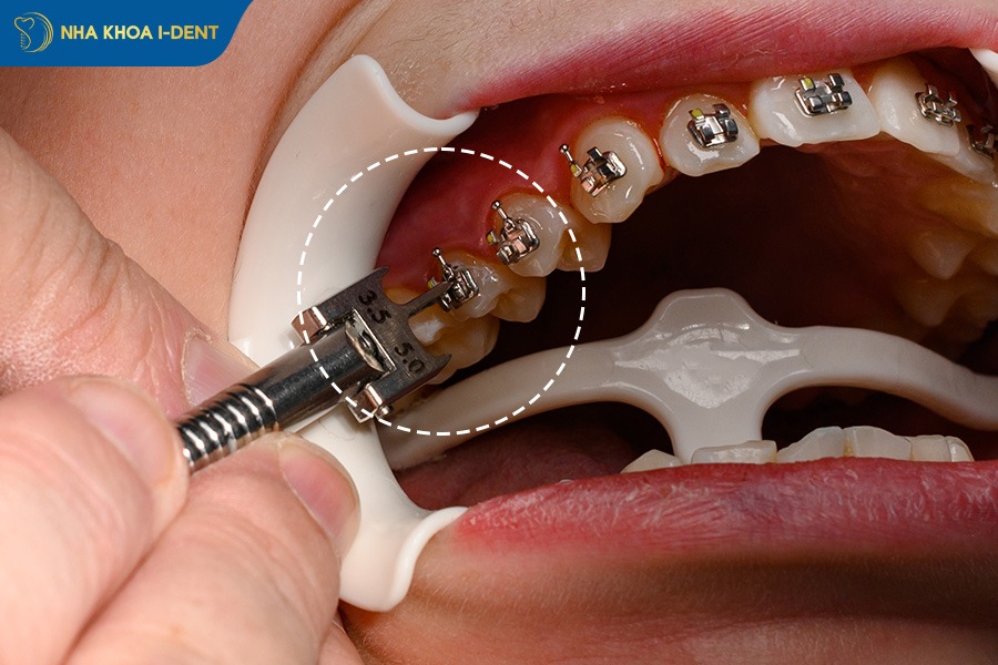 gắn mắc cài niềng răng ở răng hàm