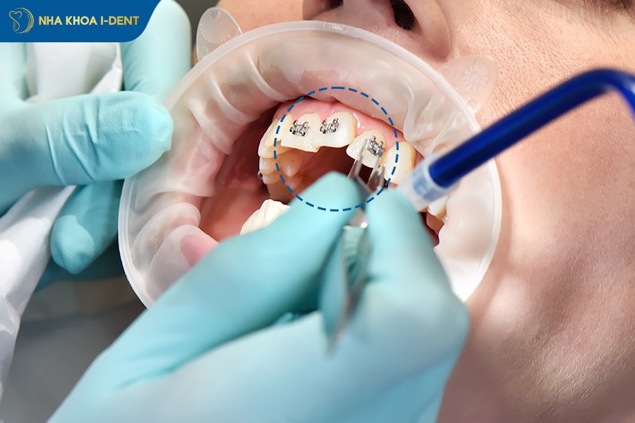 gắn mắc cài niềng răng ở răng cửa