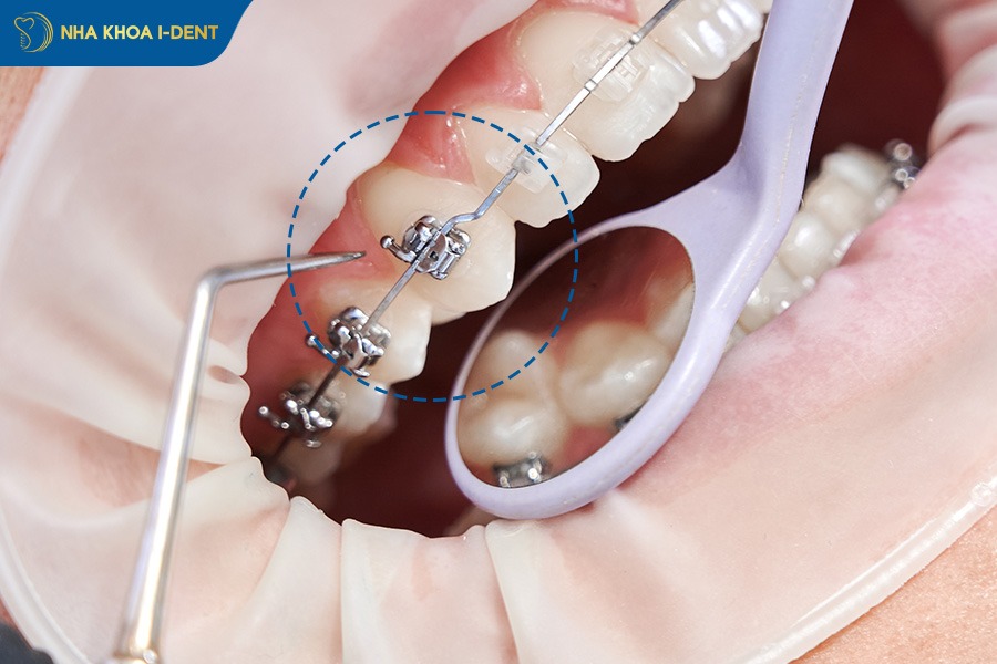 gắn mắc cài niềng răng ở răng nanh